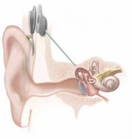 ASL Cochlear Implant