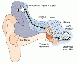 cochlear-implant-graphic